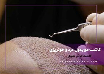 کاشت مو بدون درد و خونریزی